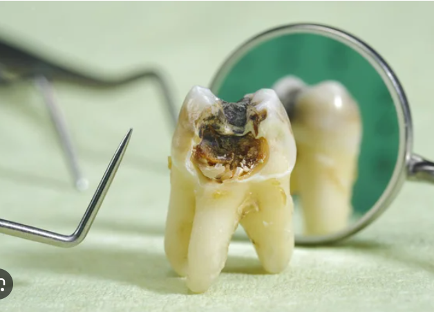 diş çürüklükleri